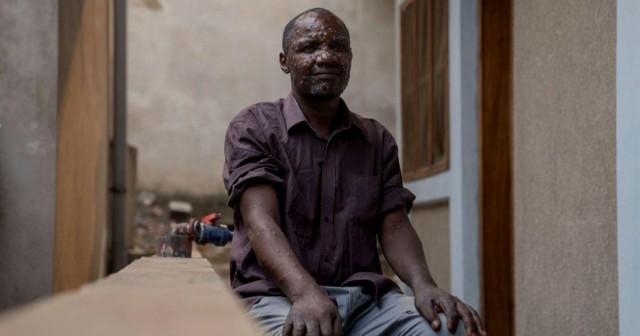 Jean Kakuru Biyambo, 48, a father of six from the Muja internally displaced persons camp, poses for a photograph outside his room at the Goma general hospital where he has been receiving treatment against Mpox - an infectious disease caused by the monkeypox virus that spark-off a painful rash, enlarged lymph nodes and fever; following Mpox cases in Nyiragongo territory, in Goma, North Kivu province, Democratic Republic of the Congo. July 16, 2024. REUTERS/Arlette Bashizi