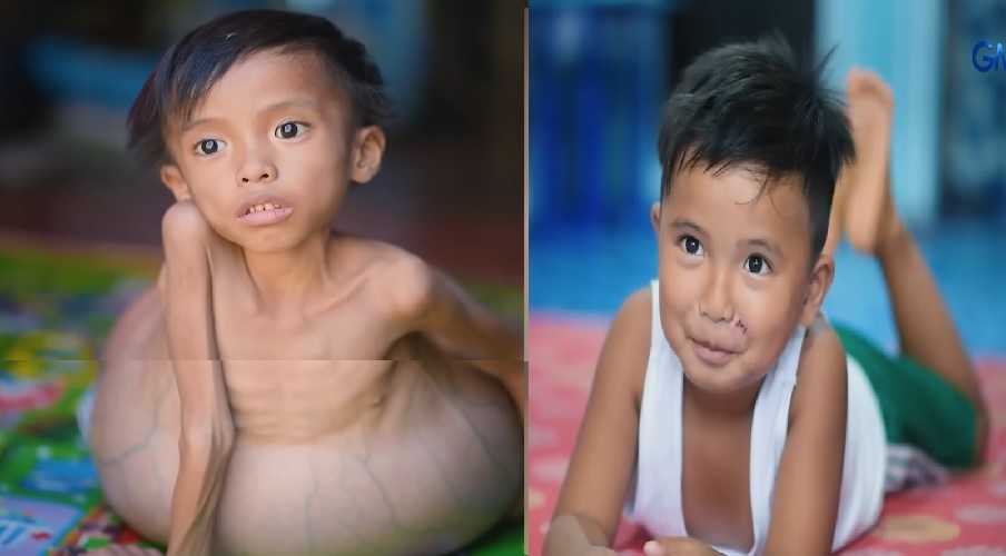 Batang halos pumutok ang tiyan sa laki, iba na ang hitsura nang maoperahan matapos maitampok sa 'KMJS' thumbnail