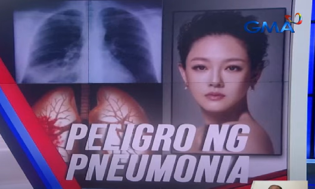 Ano nga ba ang influenza-induced pneumonia na ikinamatay ni Barbie Hsu?