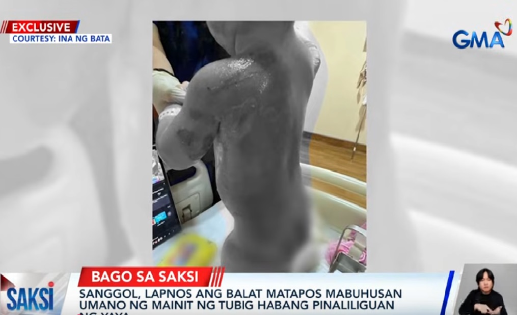 Sanggol, nalapnos ang balat nang mabuhusan umano ng mainit na tubig habang pinaliliguan ng yaya