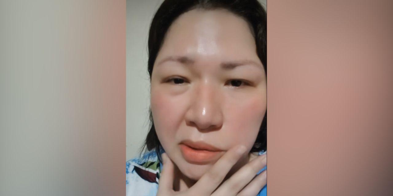 Frenchie Dy suffers third Bell's palsy attack