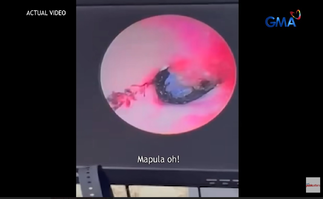 Insekto na pumasok sa tainga ng isang lalaki, nagkalasog-lasog