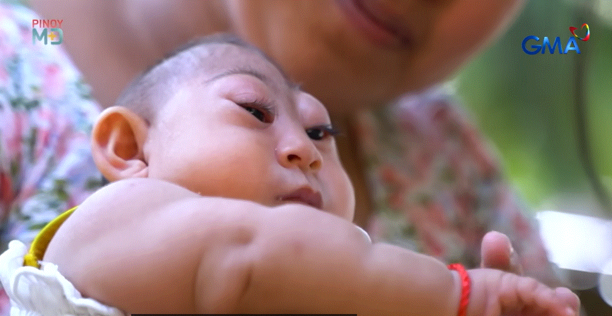 Sanggol na isinilang na maliit ang ulo o may microcephaly, patuloy na lumalaban sa buhay thumbnail