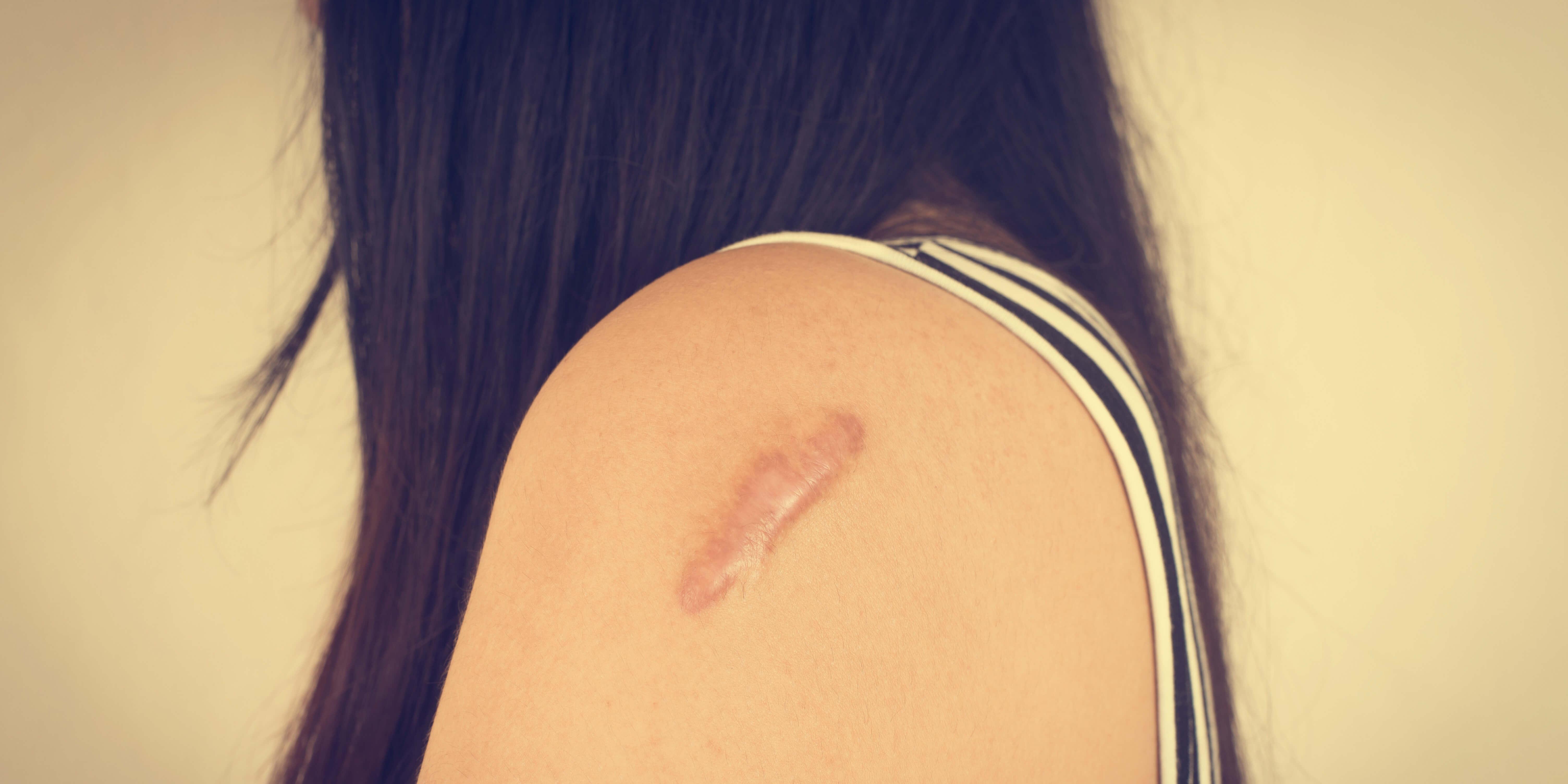 Sebo de Macho, calamansi, and more: Dr. Vicki Belo weighs in on scar remedies Filipinos swear by