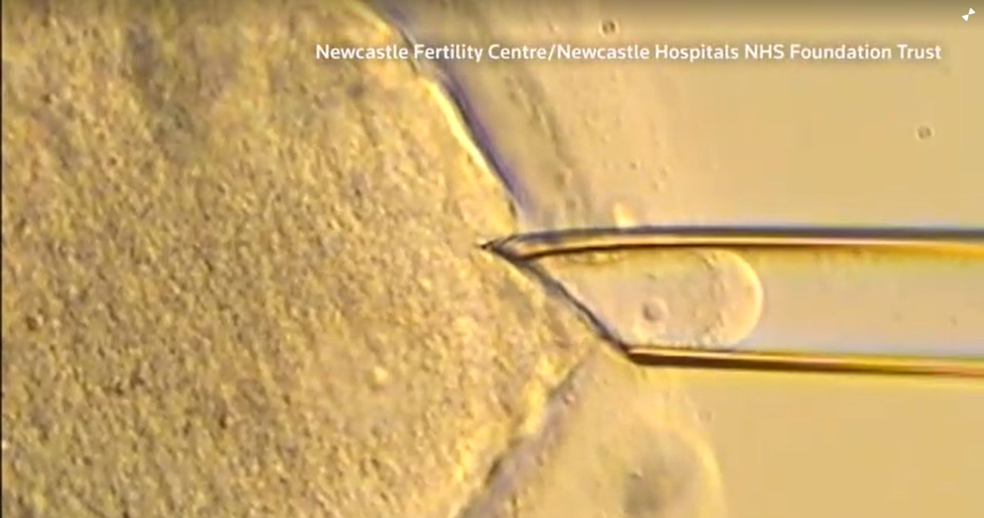 Three-person IVF technique spared children from inherited diseases, scientists say