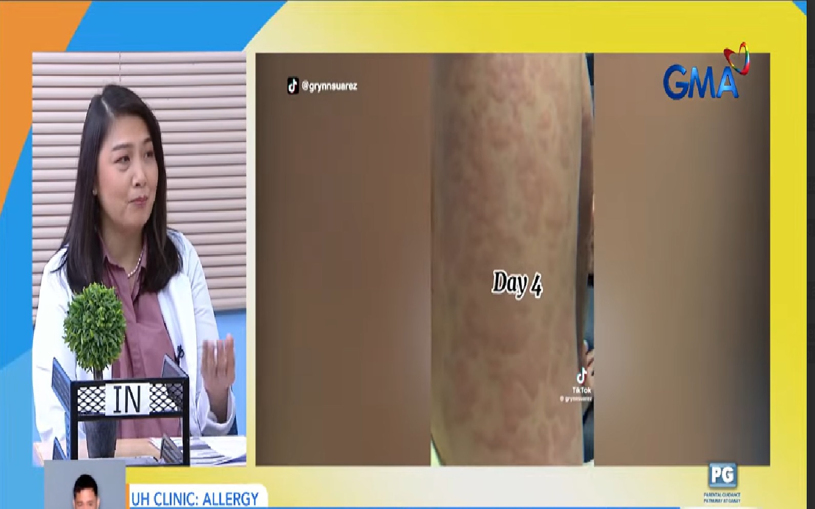 Allergy, anu-ano ang sanhi at paano ito maiiwasan? thumbnail