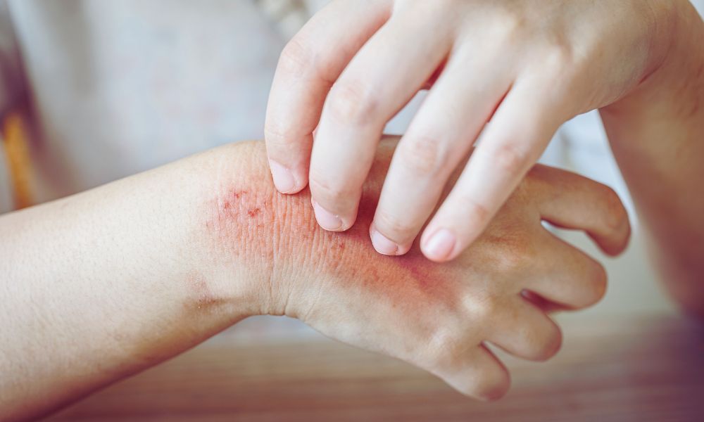 DOH warns microabrasions can be entry points for leptospirosis-causing bacteria