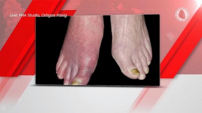 Peripheral arterial disease affects many heart patients, the PHA said, many of whom might not even show obvious symptoms. Pallor in the extremities could be a sign of PAD. Image from Philippine Heart Association