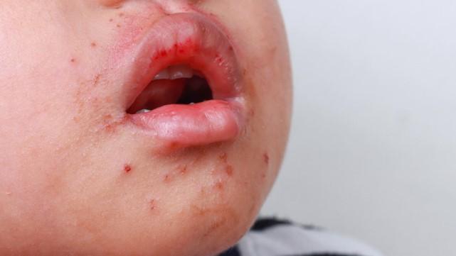 DOH: HFMD cases soar 7 times vs. year-ago, hit over 37,000 