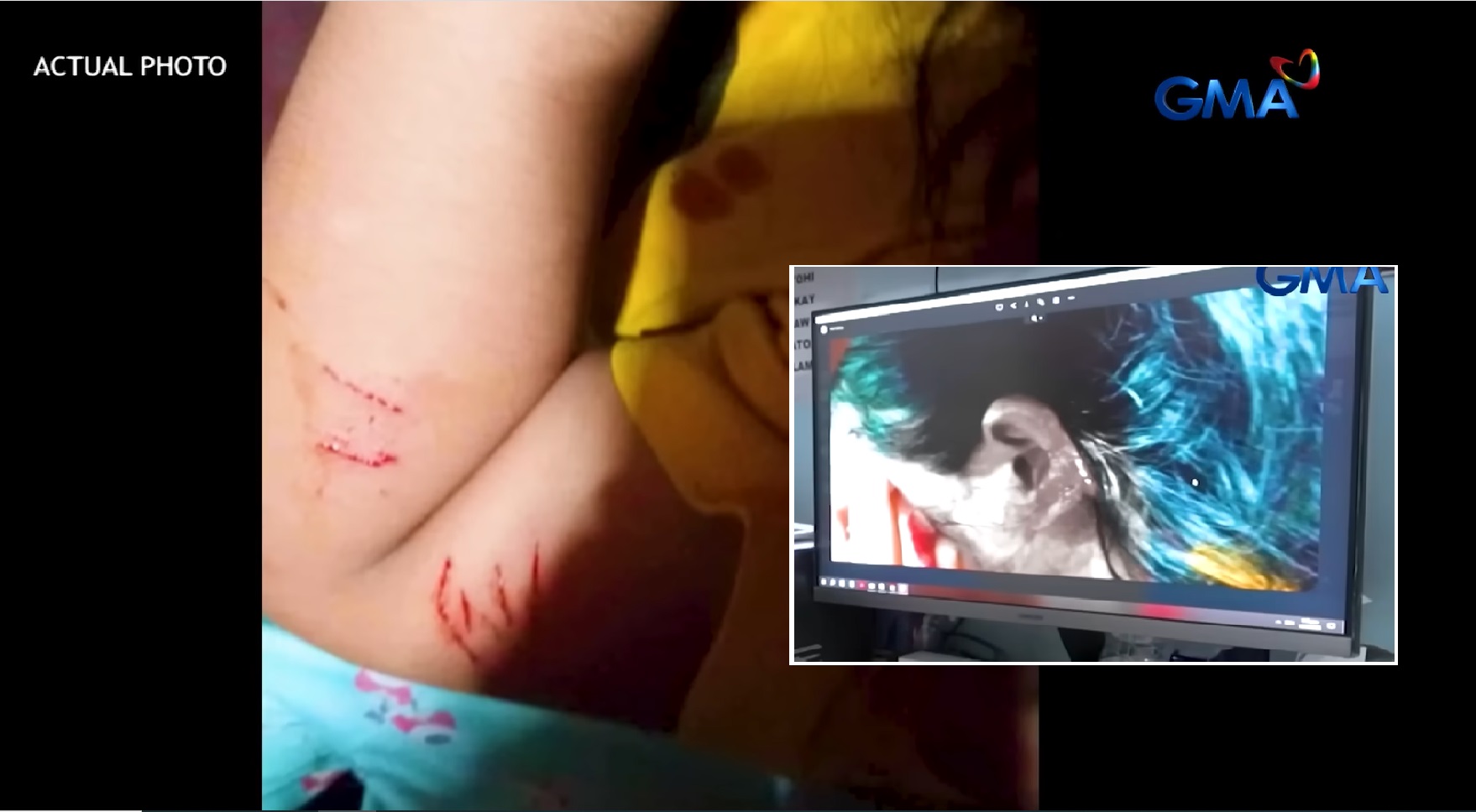 Dalagita na may kalmot sa braso at napunit ang tenga, gawa nga ba ng aswang? thumbnail