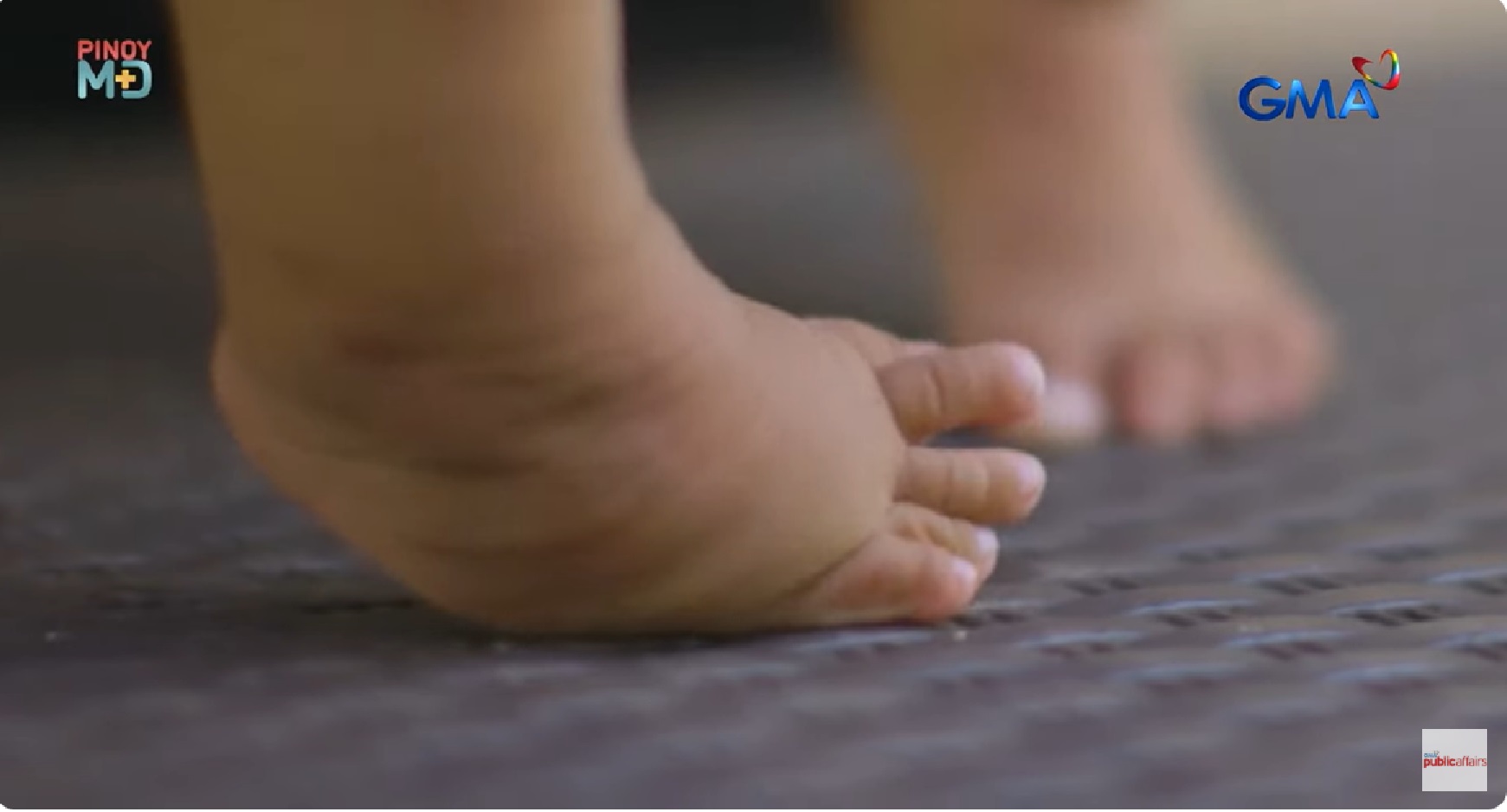 Clubfoot o depekto sa paa na baliko, maaari pa bang maisaayos? thumbnail