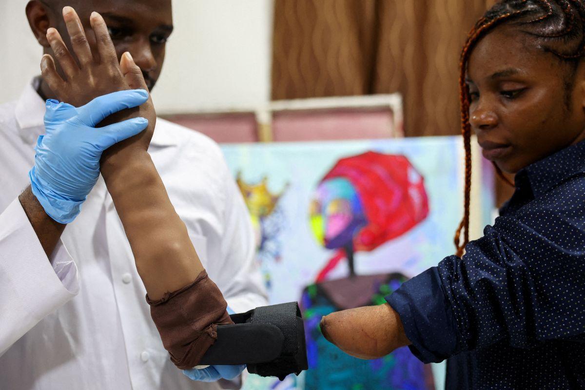 Nigerian firm develops bionic arms for amputees