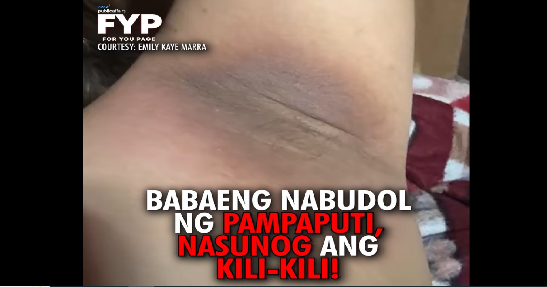 Babae, nagka-rashes at nangitim ang kilikili dahil sa whitening cream na nabili online