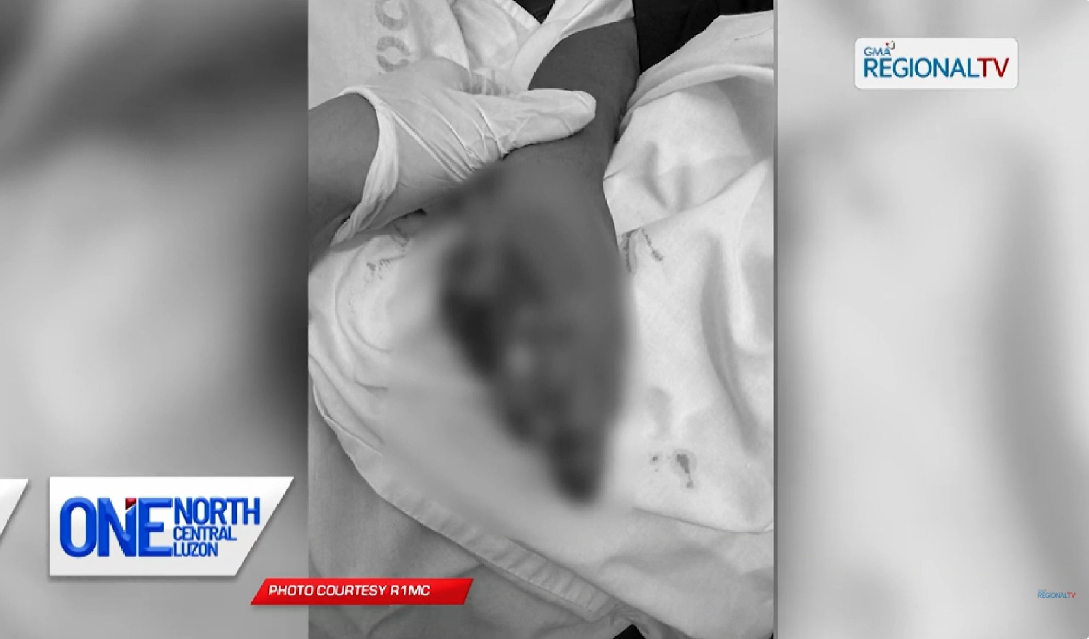 11-anyos na lalaki, nawasak ang kamay matapos masabugan ng pinulot na paputok