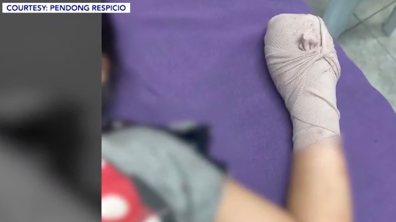 10-year-old girl loses hand to ‘dart bomb’ set by 14-year-old boy 