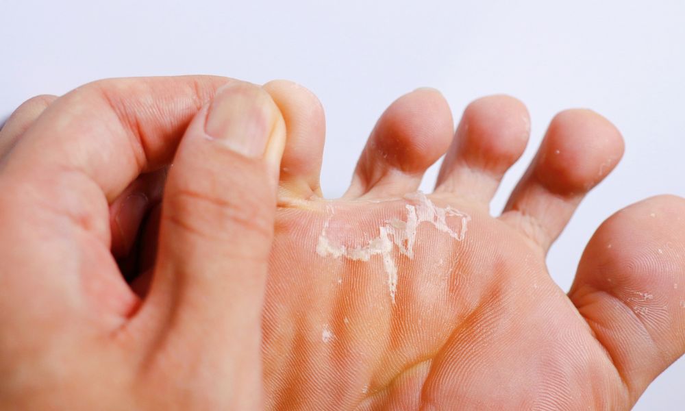Help, the skin on my feet is peeling!