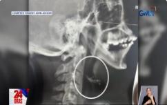 Lalaking aksidenteng nalunok ang wire ng kaniyang braces, ano kaya ang kinahinatnan?