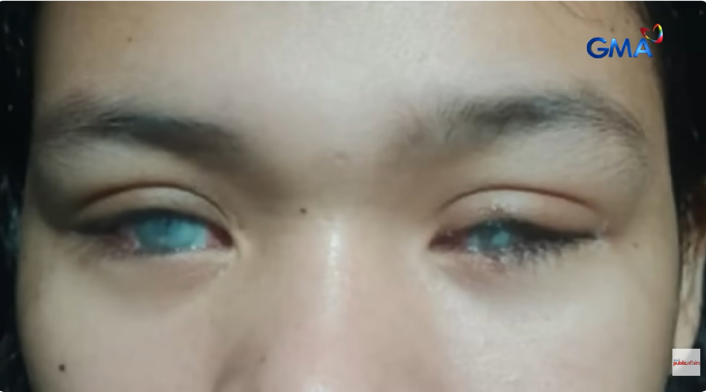 Babae, nabulag matapos sabuyan ng asido sa mukha ng asawa; pero biktima, bakit pinatawad pa rin ang suspek?