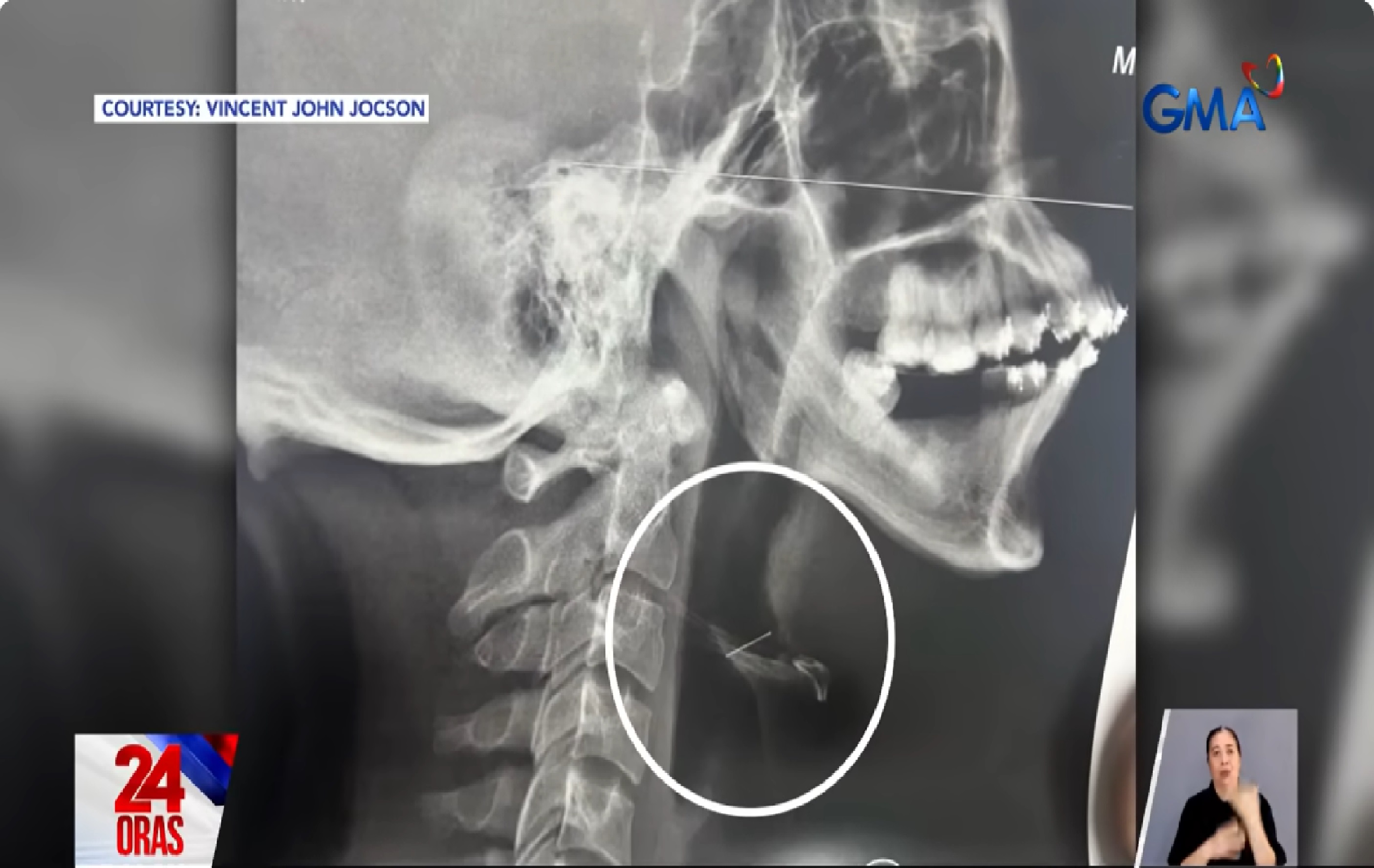 Lalaking aksidenteng nalunok ang wire ng kaniyang braces, ano kaya ang kinahinatnan?