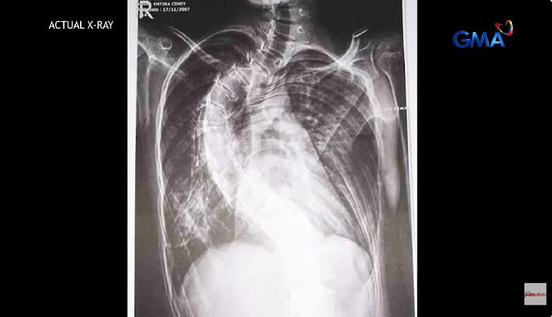 Dalaga sa Leyte na iniinda ang kaniyang problema sa kulugod, maaari pa kayang gamutin?