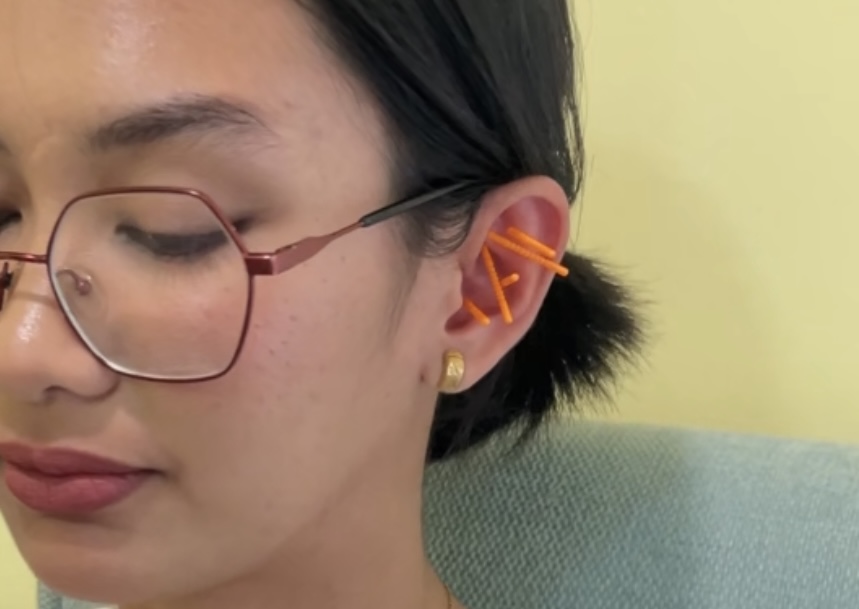 Ear acupuncture: What to know about the treatment said to help with stress and anxiety, and where to try it in Manila 