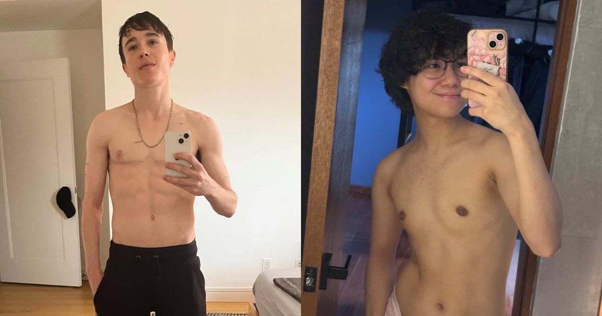 Top surgery for transmen: How it works and why it's important for some