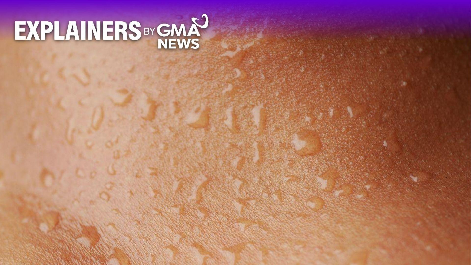 Chafing in the intense Philippine heat? Expert shares causes, treatment, prevention