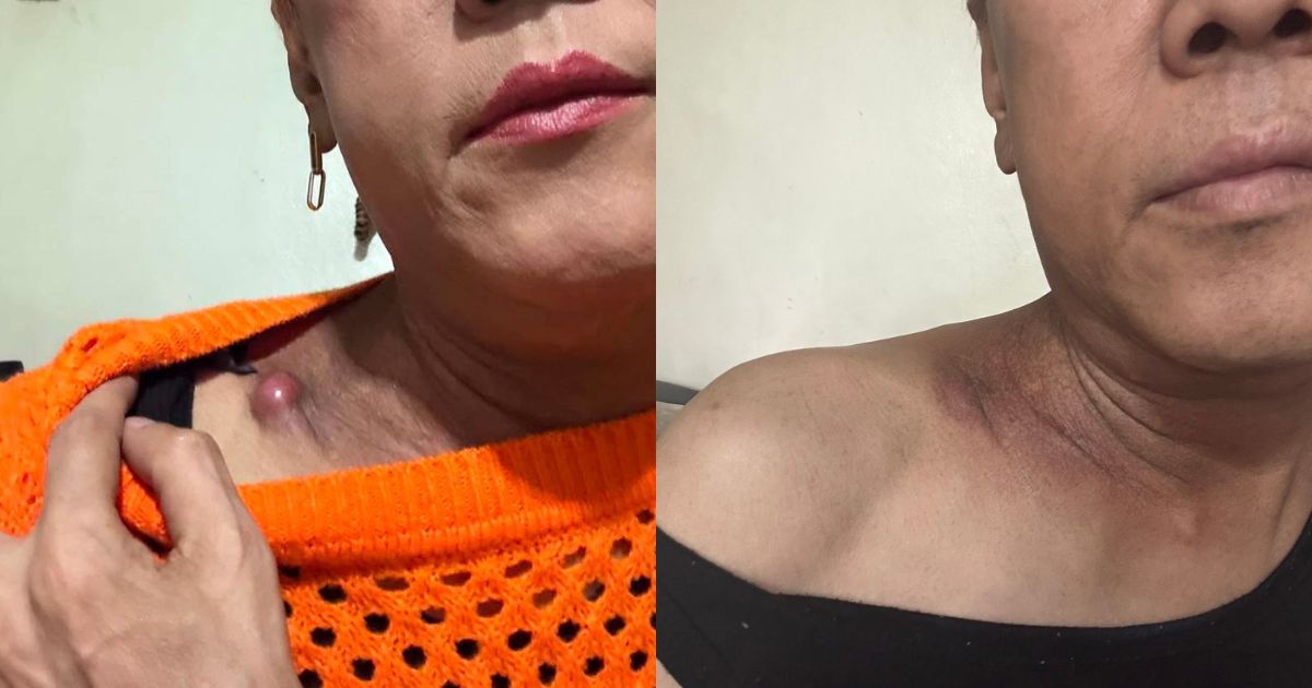 Ate Gay shares positive updates as neck lump continues to shrink after treatment
