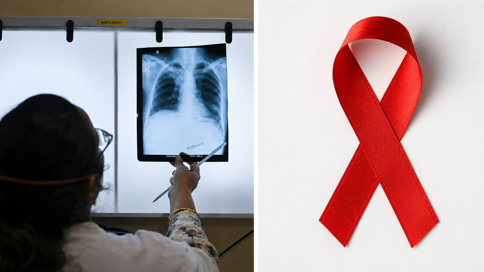 Philippines, US commit P42B to strengthen country's HIV, tuberculosis response