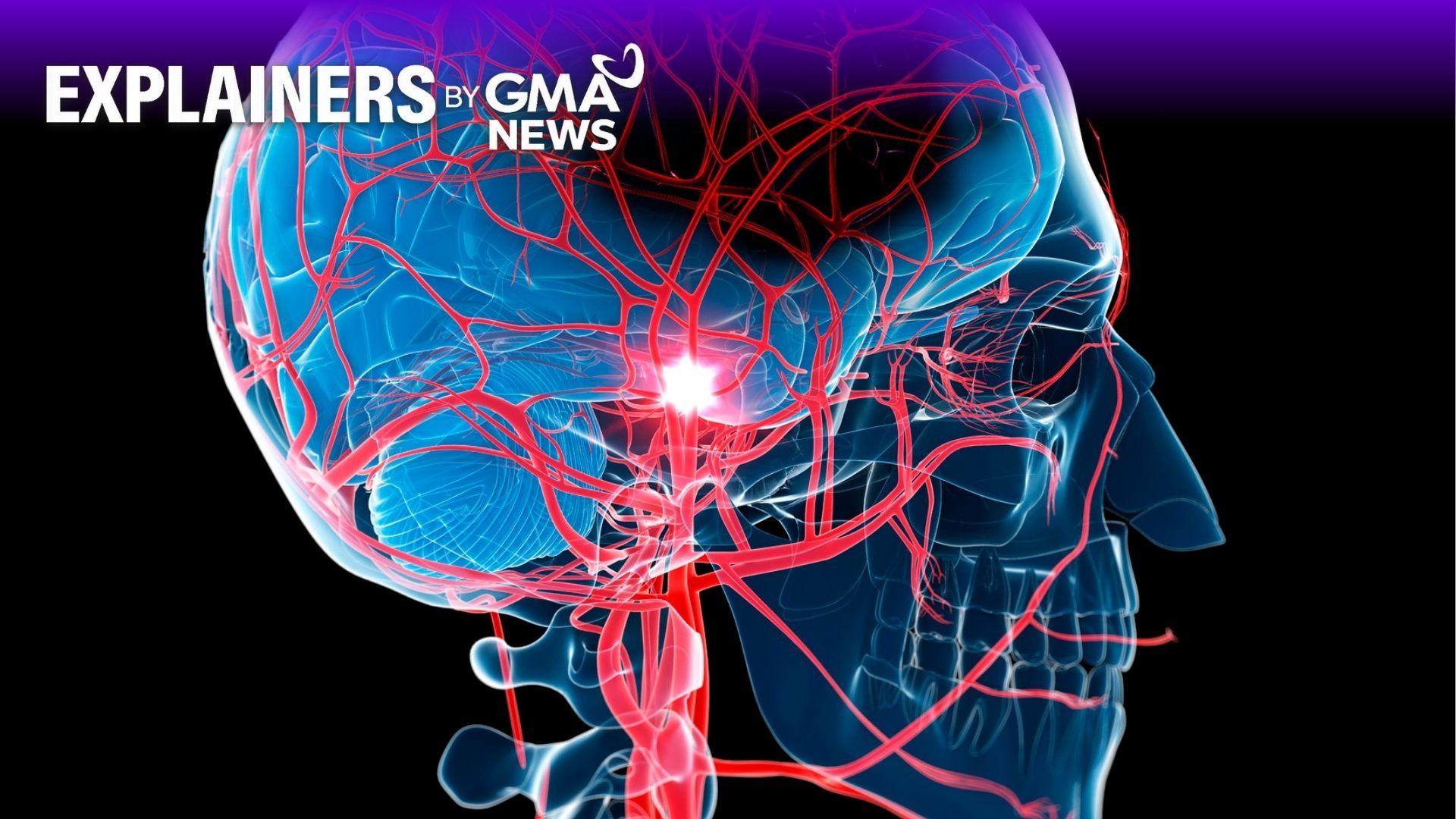 Is stroke hereditary? Neurologist answers