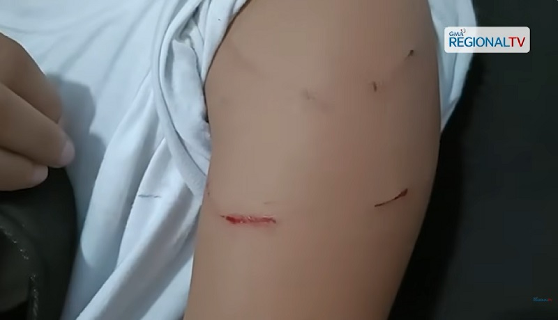 Grade 7 student, sugatan matapos umanong pagpapaluin ng patpat ng kaniyang guro sa Bacolod City