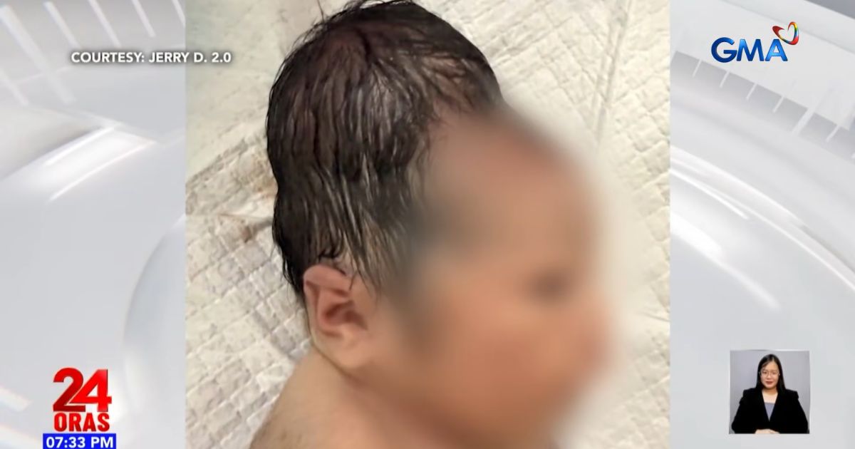 Why did this newborn's head look swollen and elongated after birth? Medical experts explain