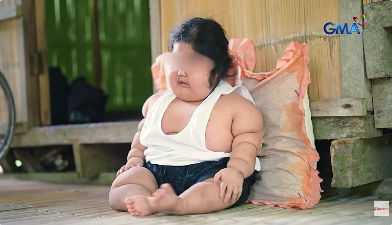 5-anyos na bata na lumobo ang mga braso, binti at mukha, at hindi rin makatayo, ano kaya ang kondisyon?
